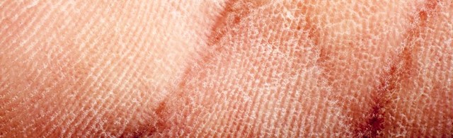 Jak sobie radzić z atopowym zapaleniem skóry?